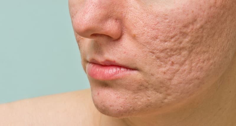Acne-prone skin close-up