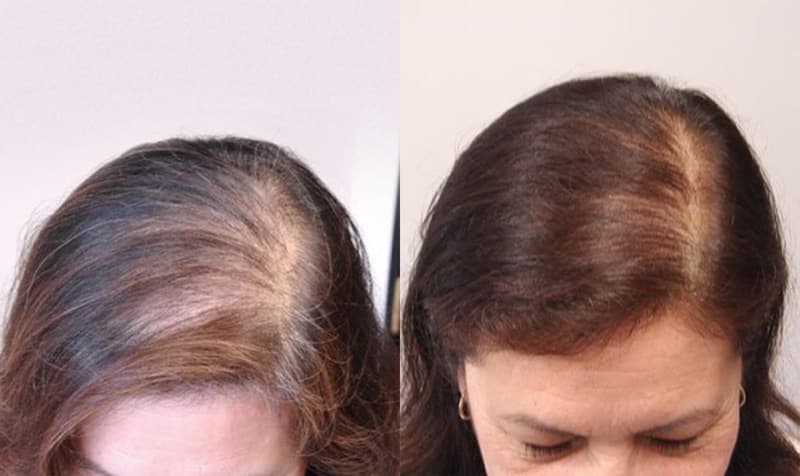 Thinning hair at the parting line